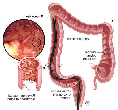 A: Appearance of FAP inside of the colon; B: endoscopic image of polyps; C: enlargement of polyps in the colon.